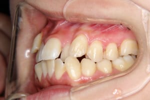 前歯部の叢生と八重歯が主訴でした。